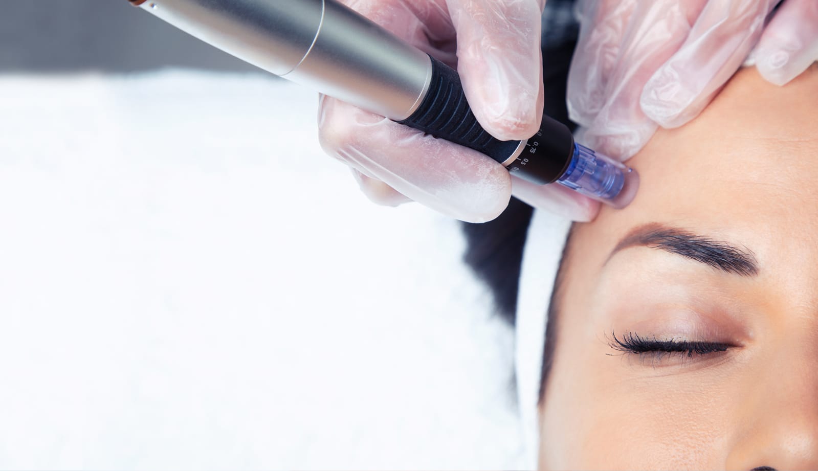 Dermapen kezelés az Apollon Beauty kozmetika kínálatában